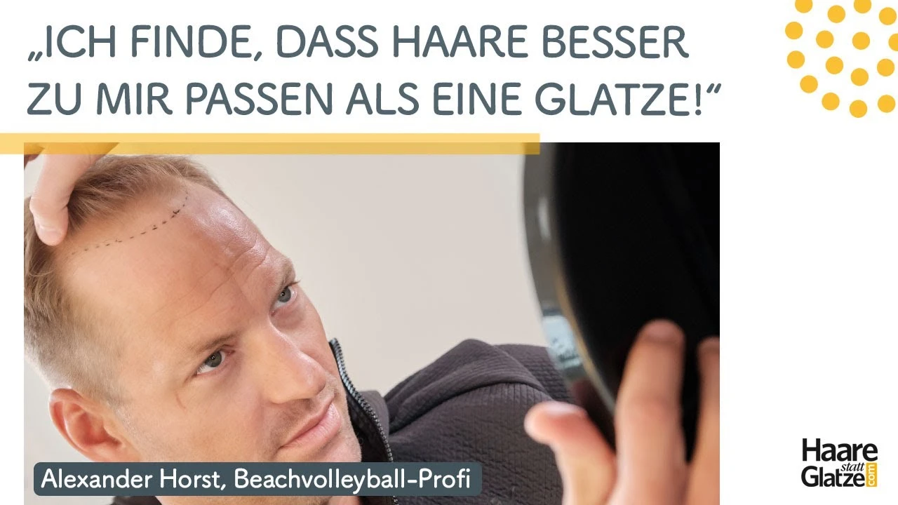 Alexander Horst - Haartransplantation von Beachvolleyball-Star | #ichhabsgemacht