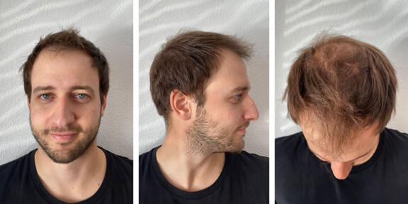 6 Monate nach der Haartransplantation