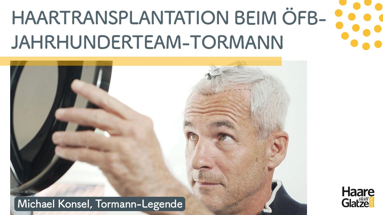 Haartransplantation bei Michael Konsel: So lief seine Behandlung 2021 bei Moser Medical ab