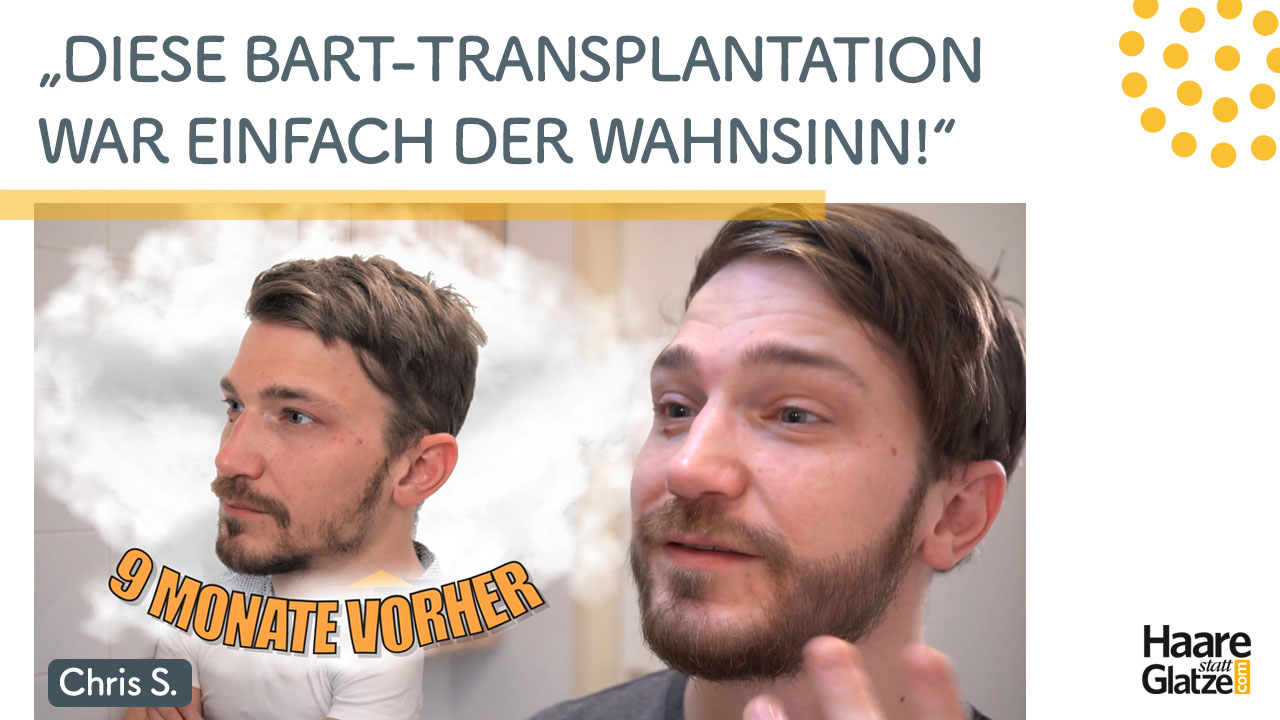 Bart Haartransplantation vorher nachher: "Ich genieße die Vorteile des vollen Barthaars!"