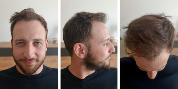 1 Jahr nach der Haartransplantation