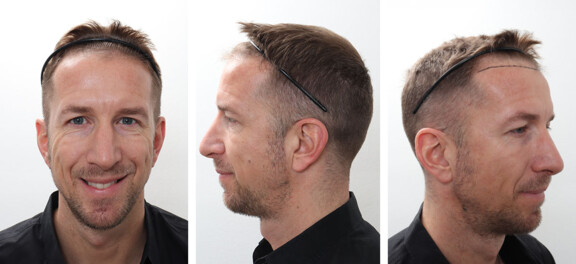 3 Monate nach der Haartransplantation